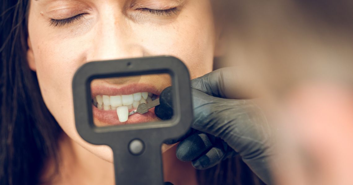 10 Principais dúvidas sobre Implantes Dentários | Smille Odontologia