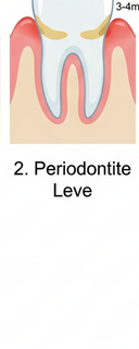 FASE 2: Periodontite Leve