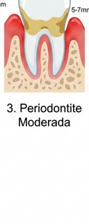 FASE 3: Periodontite Moderada