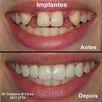 Resultado de Implante