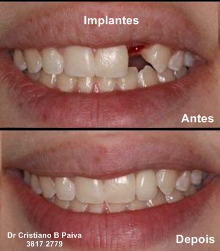 Resultado de Implante
