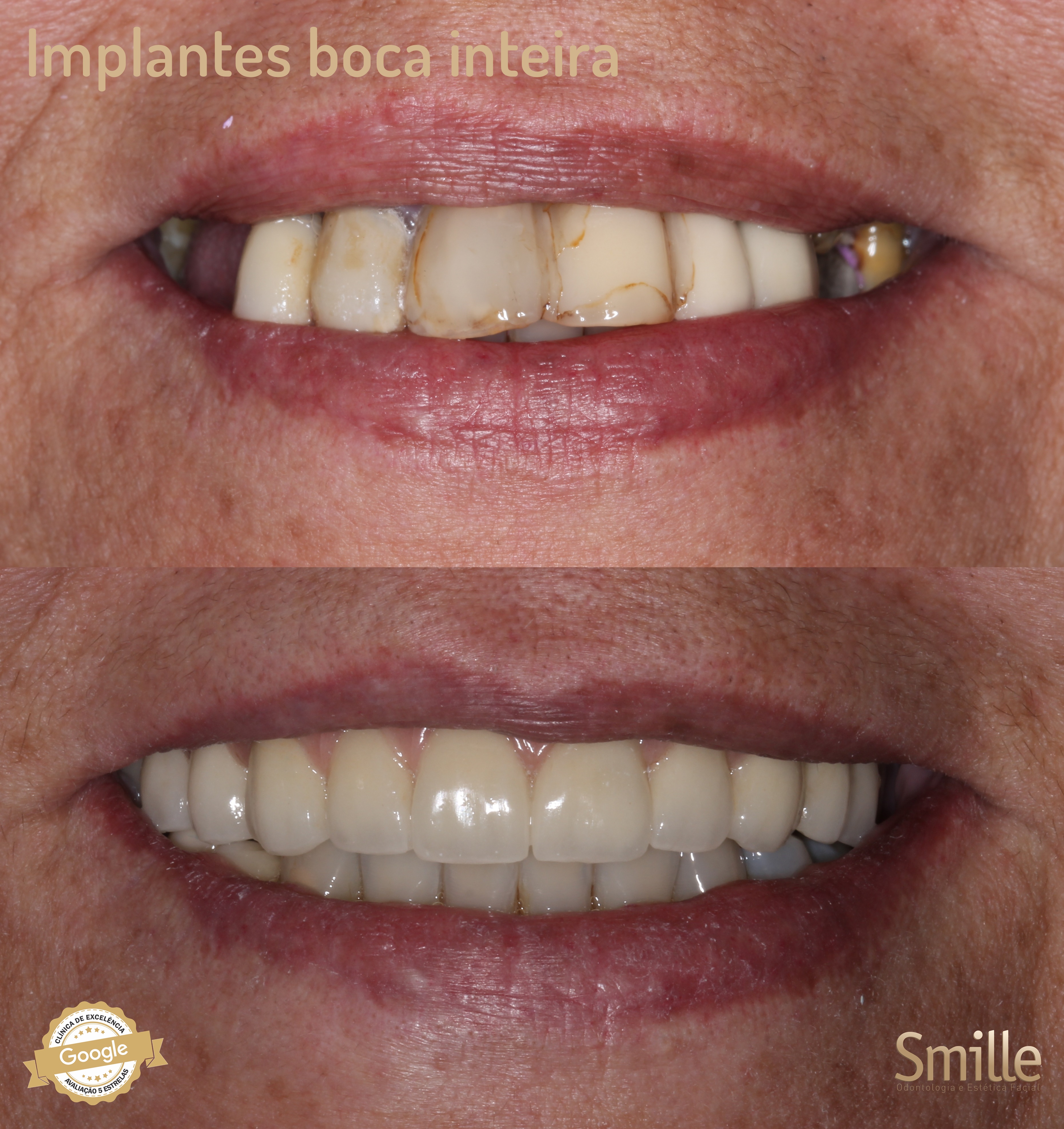 Resultado de Implante