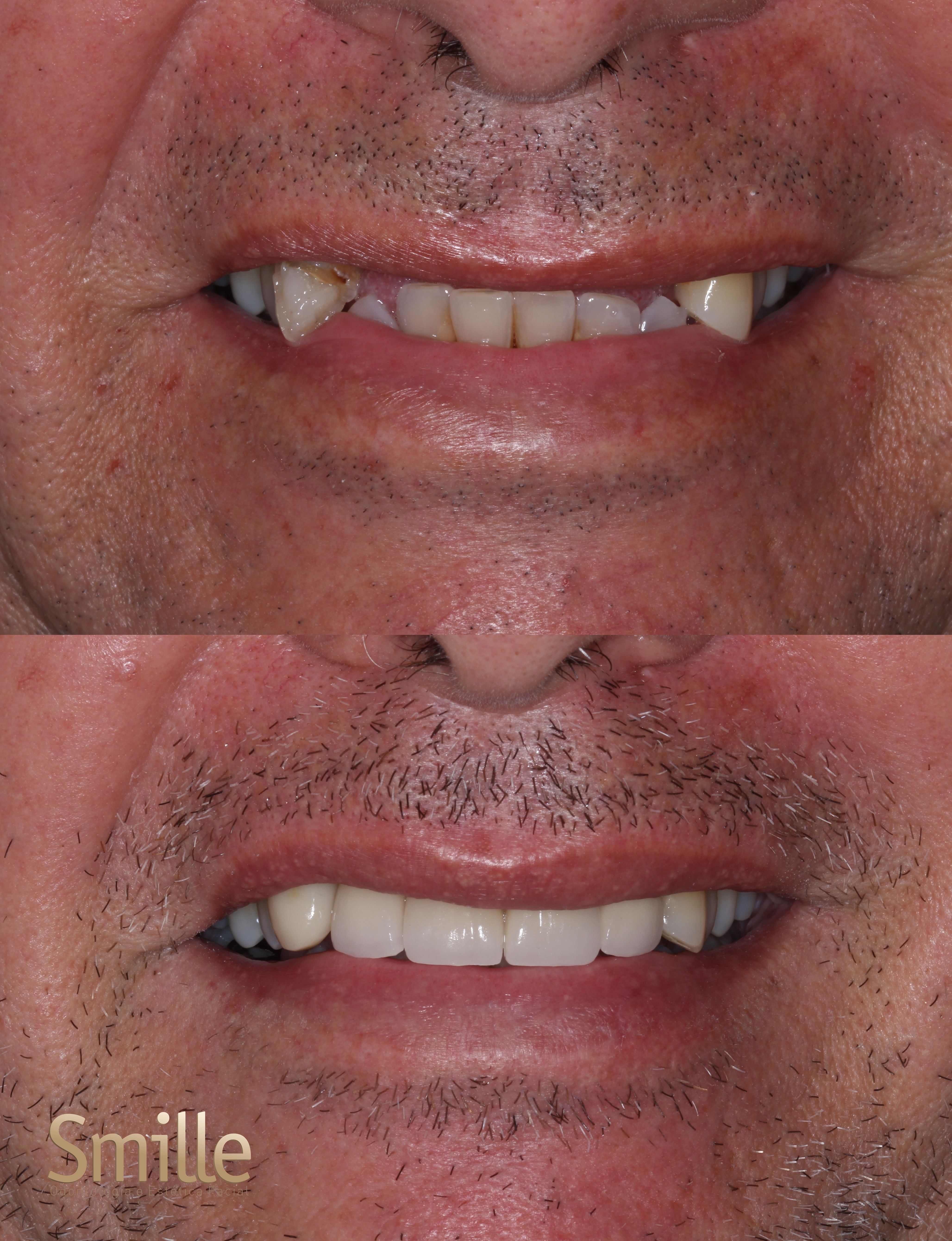 Resultado de Implante