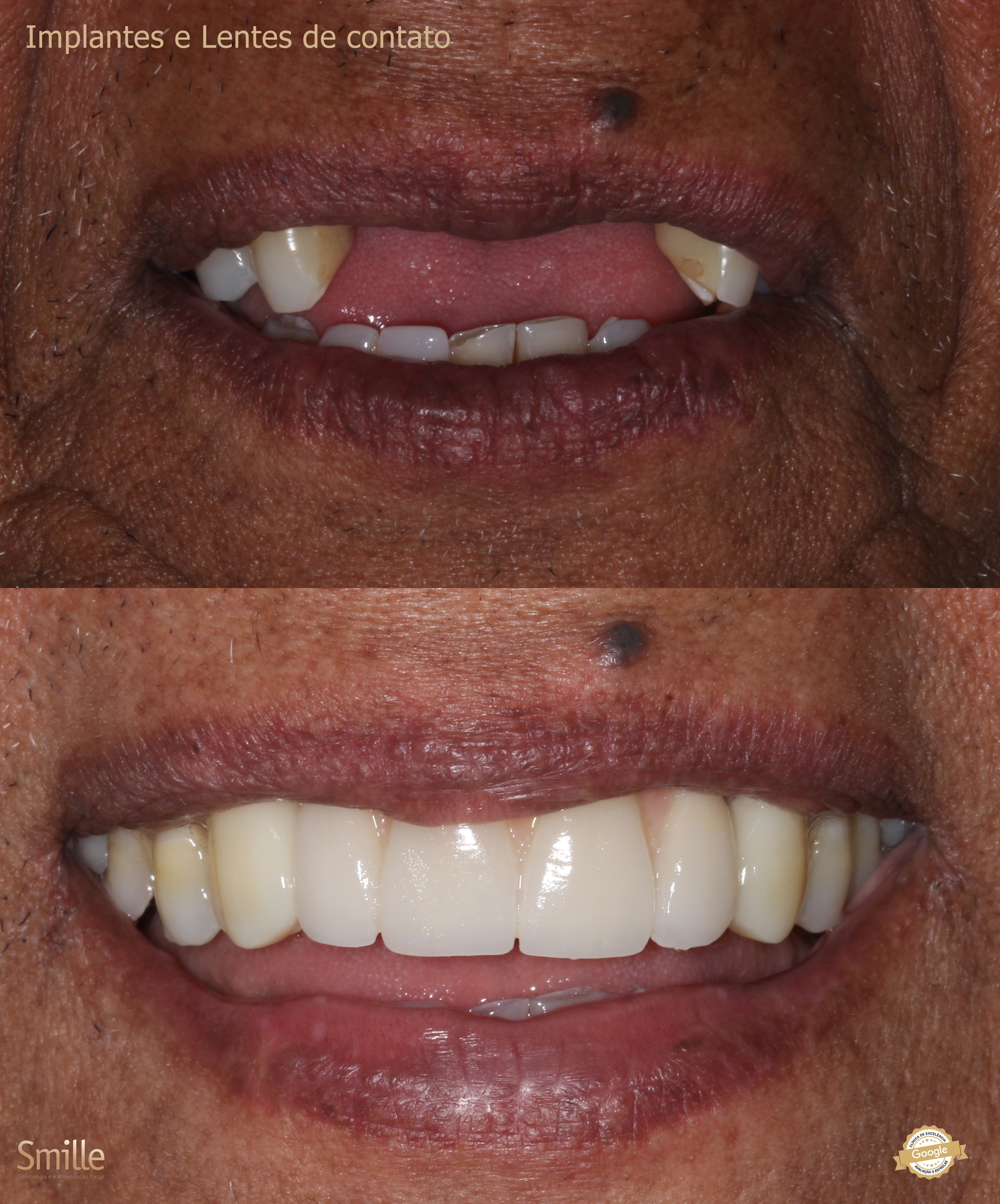 Resultado de Implante