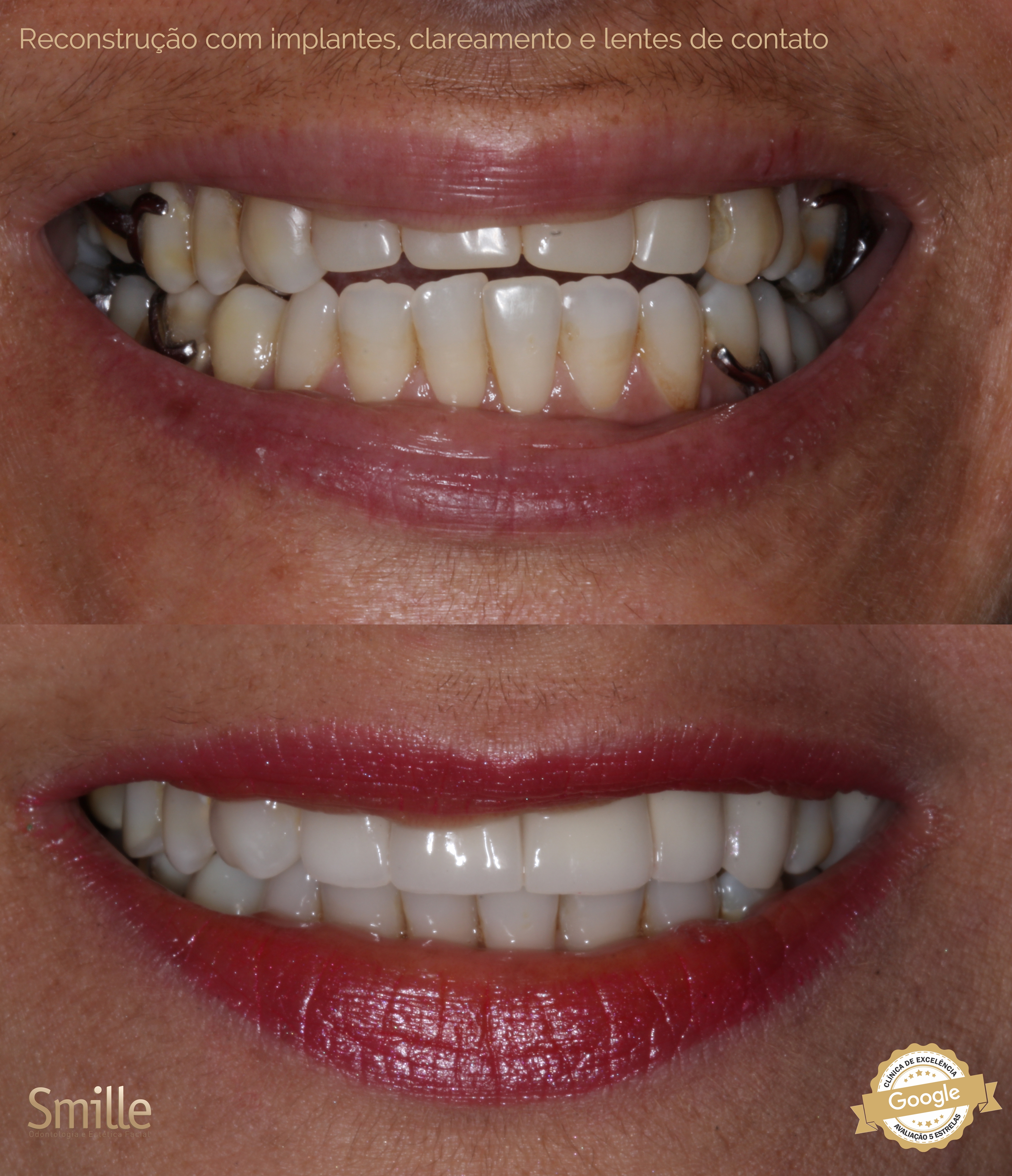 Resultado de Implante