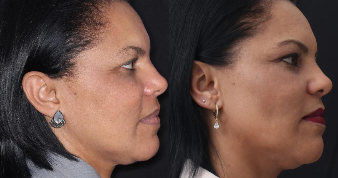 FaceFit Emagrecimento Facial e Lipo de Papada